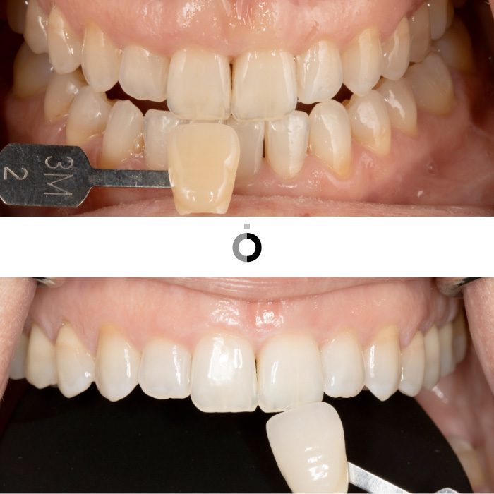 antes y después de un blanqueamiento dental
