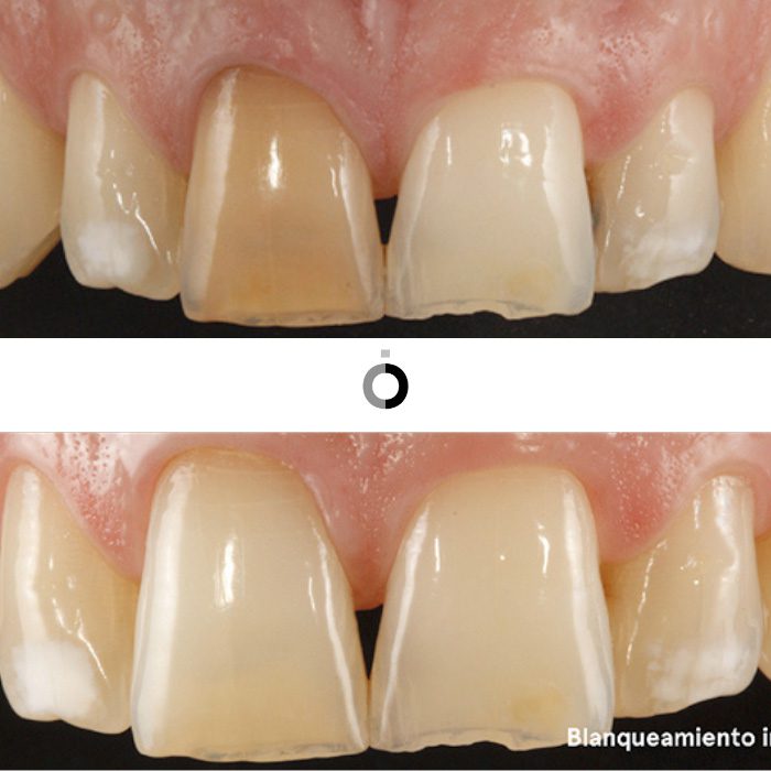 porqué hacerse un blanqueamiento dental, antes y después