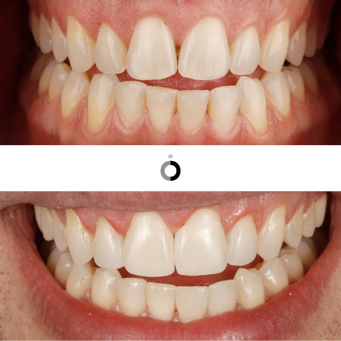 el antes y después de un tratamiento de carillas dentales bizkaia