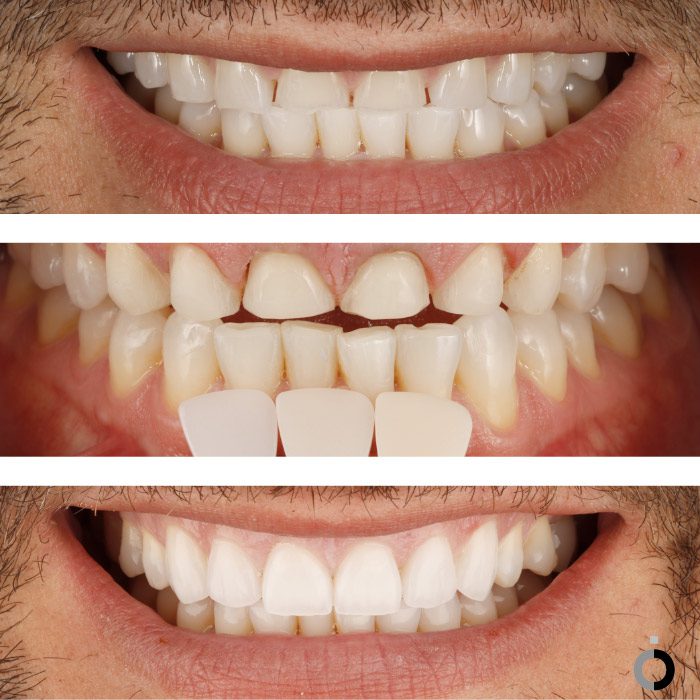 antes y después carillas dentales