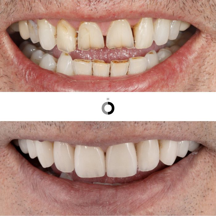 antes y después de carillas dentales