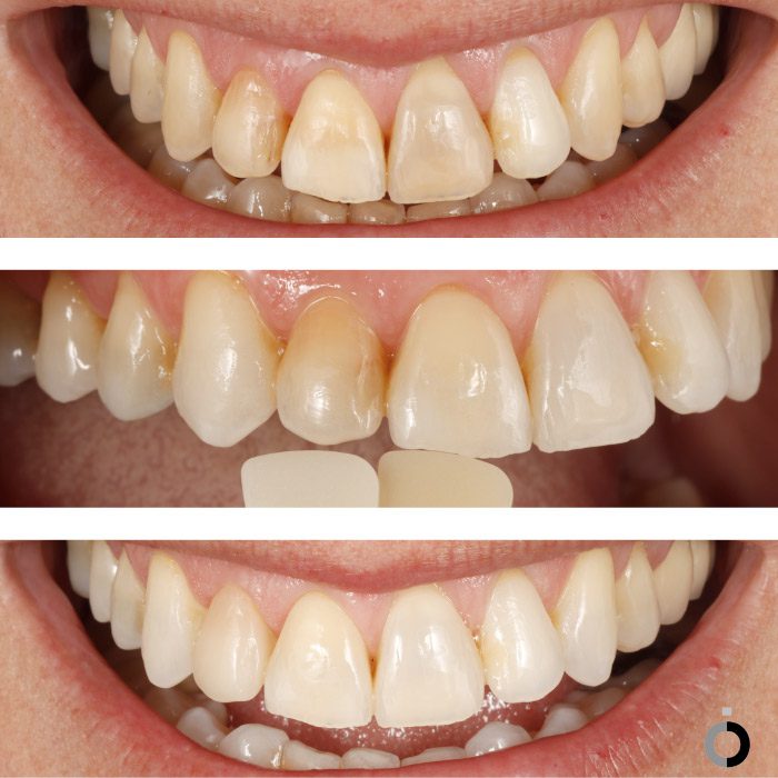 antes y después carillas dentales en bilbao