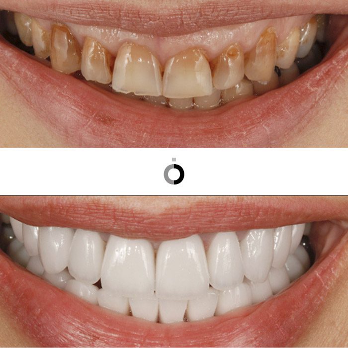 antes y después del tratamiento de carillas dentales en bizkaia