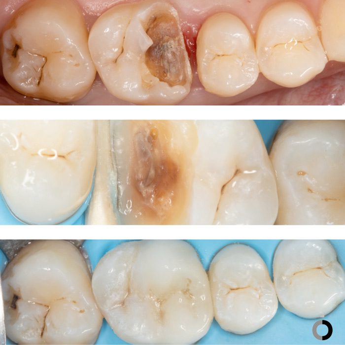 Antes y después de una odontologia conservadora en bilbao