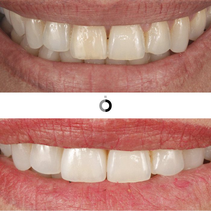 resultados y antes y después delblanqueamiento estetico dientes bilbao