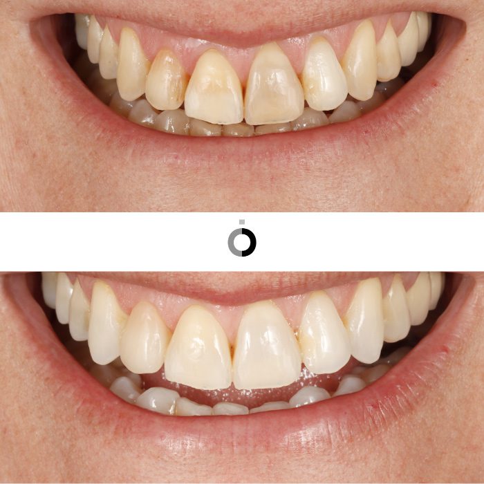 el antes y después y resultados blanqueamiento dental en bilbao