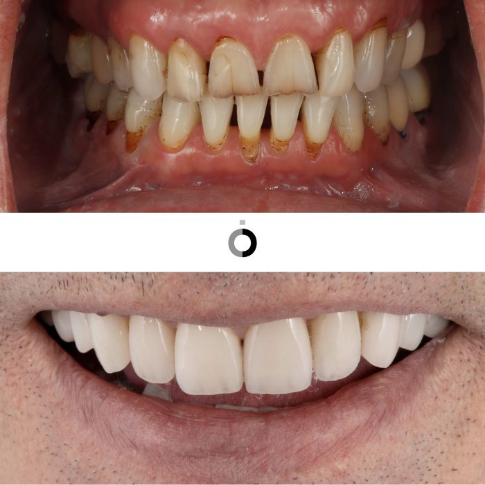 resultados odontologia estetica clinia anatomia bilbao