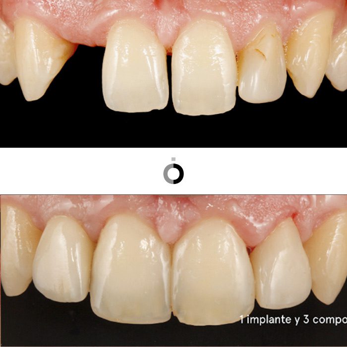 el antes y después de tratamientos de implantes dentales en Bilbao