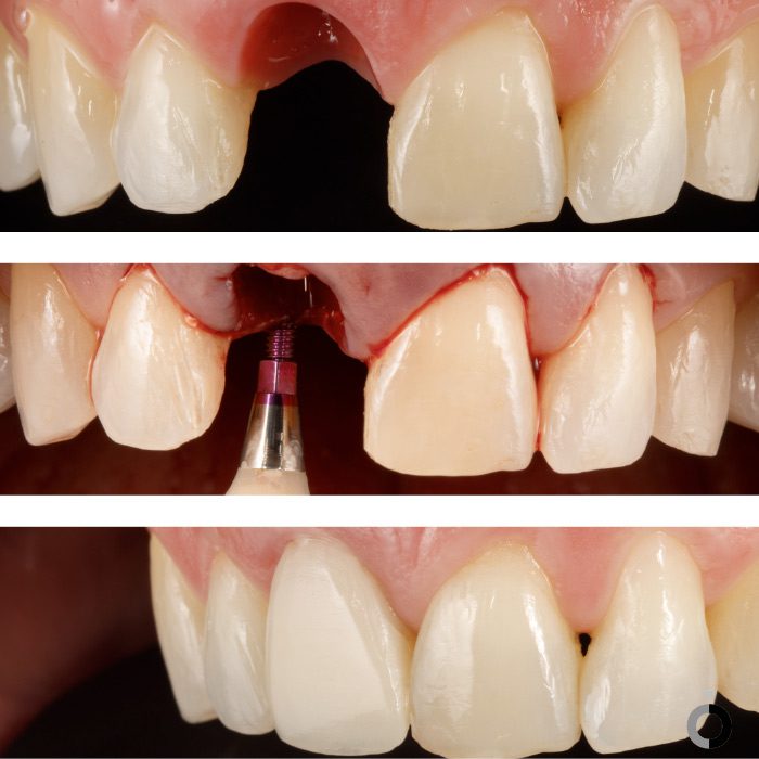 Antes y después del tratamiento de implantología dental en la clínica dental Anatômia en Bilbao