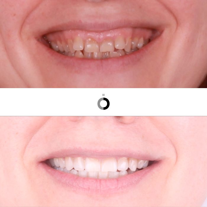 antes y después del tratamiento de ortodoncia invisible en nuestra clínica dental en Bilbao