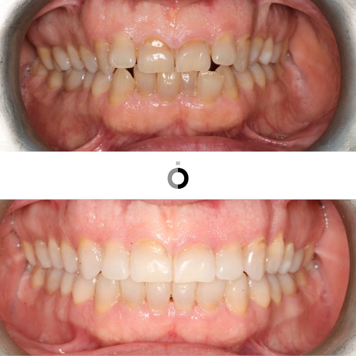 antes y después del tratamiento de invisaling en nuestra clínica dental en Bilbao