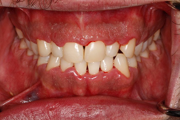 Cuidado y tratamientos de encías inflamadas por la periodontitis en la clínica dental Anatômia de Bilbao