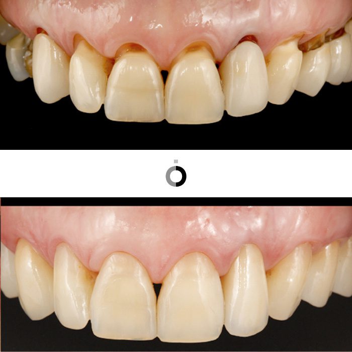 el antes y después de los tratamientos de rehabilitación oral en la clínica dental Anatômia de Bilbao