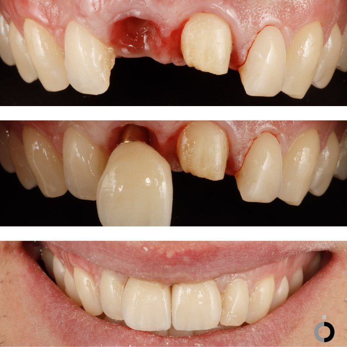 resultados después de tratamiento de implantes dentales en Bilbao en la clínica dental Anatômia