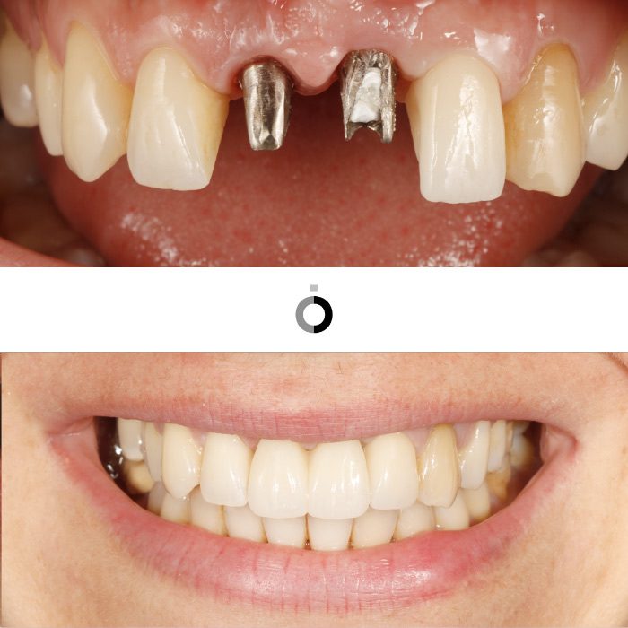 estos son los resultados tras una implantología dental con implantes en la clínica dental Anatômia en Bilbao