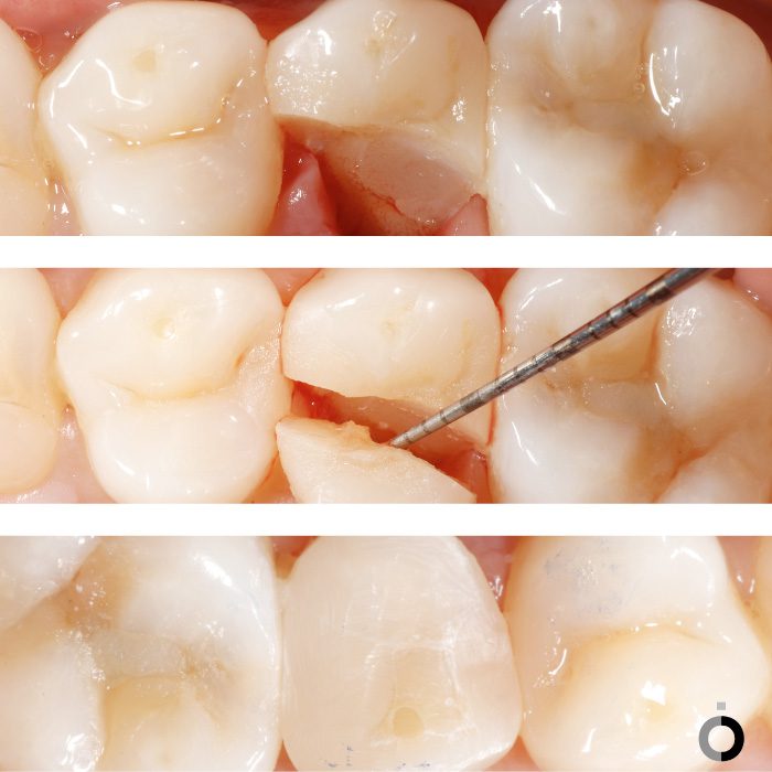 En la Clínica Dental Anatômia contamos con especialistas entratamientos de endodoncia en Bilbao