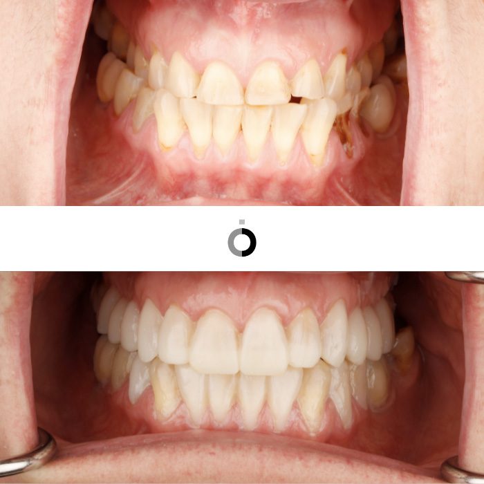 antes y después del tratamientos para desgastes dentales en la clínica dental Anatômia de Bilbao