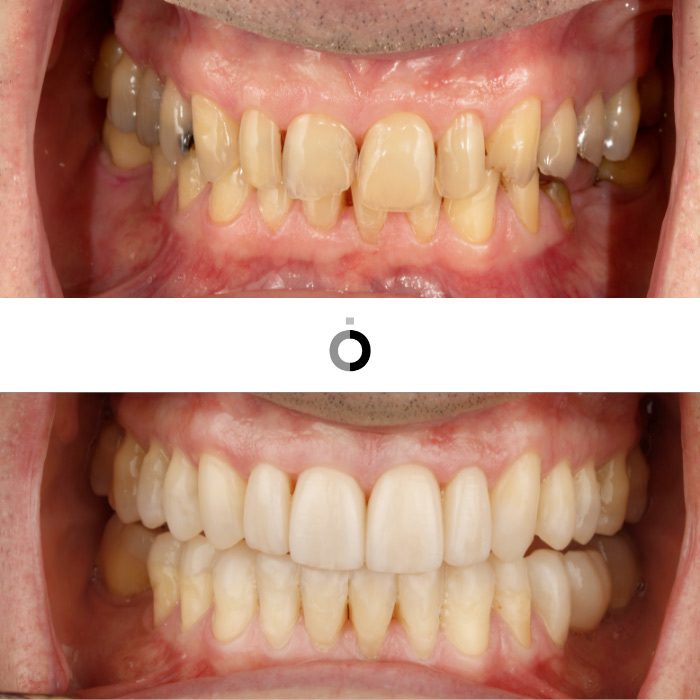 tratamientos para desgastes dentales clinica anatomia bilbao