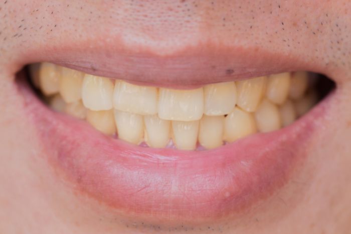 tratamiento desgaste dientes en bilbao