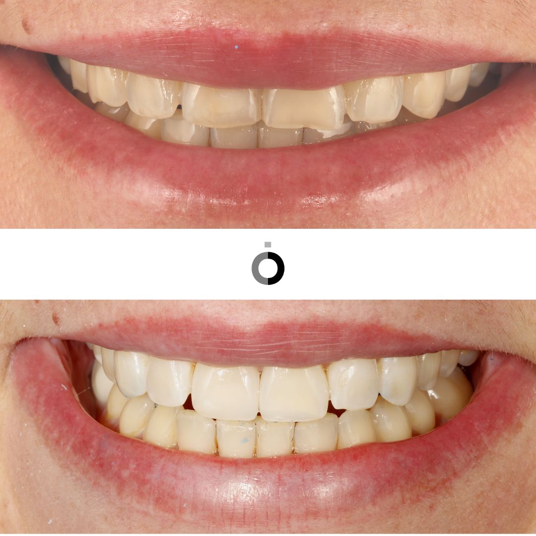 antes y después dientes desgastados tratamiento bilbao