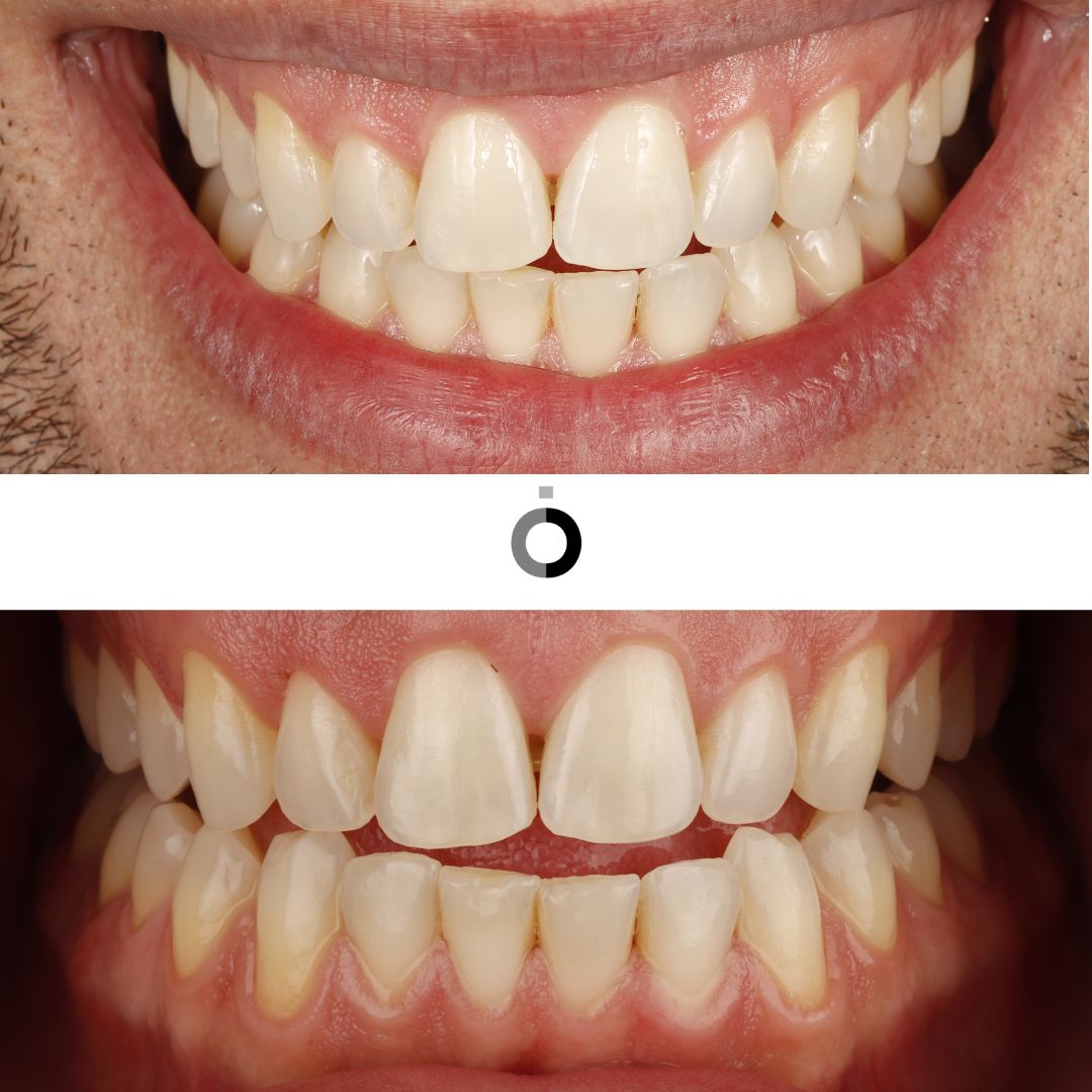 carillas dentales resultados bilbao